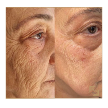 Anti Aging (Yaşlanma Karşıtı)