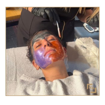 Cilt Bakım (Hydrafacial) Karbon Peeling